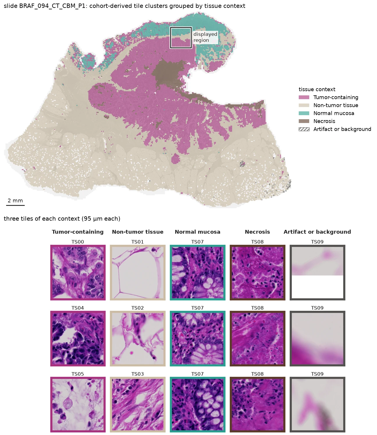 Cohort tile clusters on slide BRAF_094_CT_CBM_P1 grouped into tissue contexts, with the displayed region outlined and three H&E tiles for each context